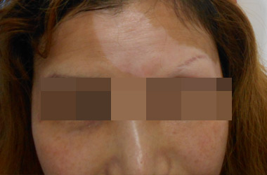 春季女性怎樣預(yù)防臉部患白癜風(fēng)呢?