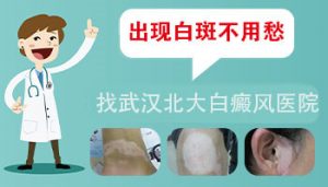 怎么看自己身上的白斑是不是白癜風(fēng)呢